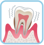 歯周病4